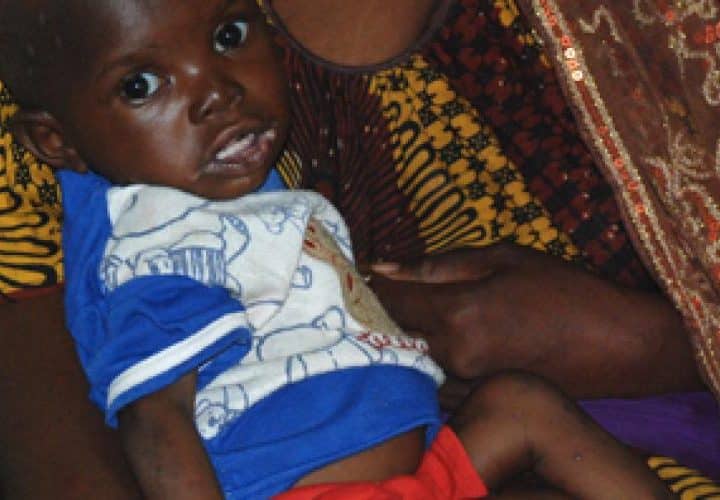 Enfant malnutri au Mali